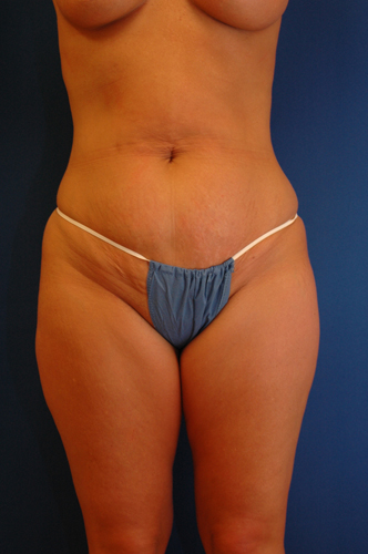 Abdominoplasty Before and After | Brzowski Plastic Surgery