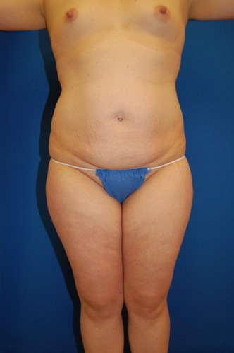 Abdominoplasty Before and After | Brzowski Plastic Surgery