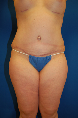 Abdominoplasty Before and After | Brzowski Plastic Surgery