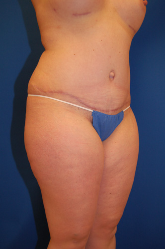 Abdominoplasty Before and After | Brzowski Plastic Surgery